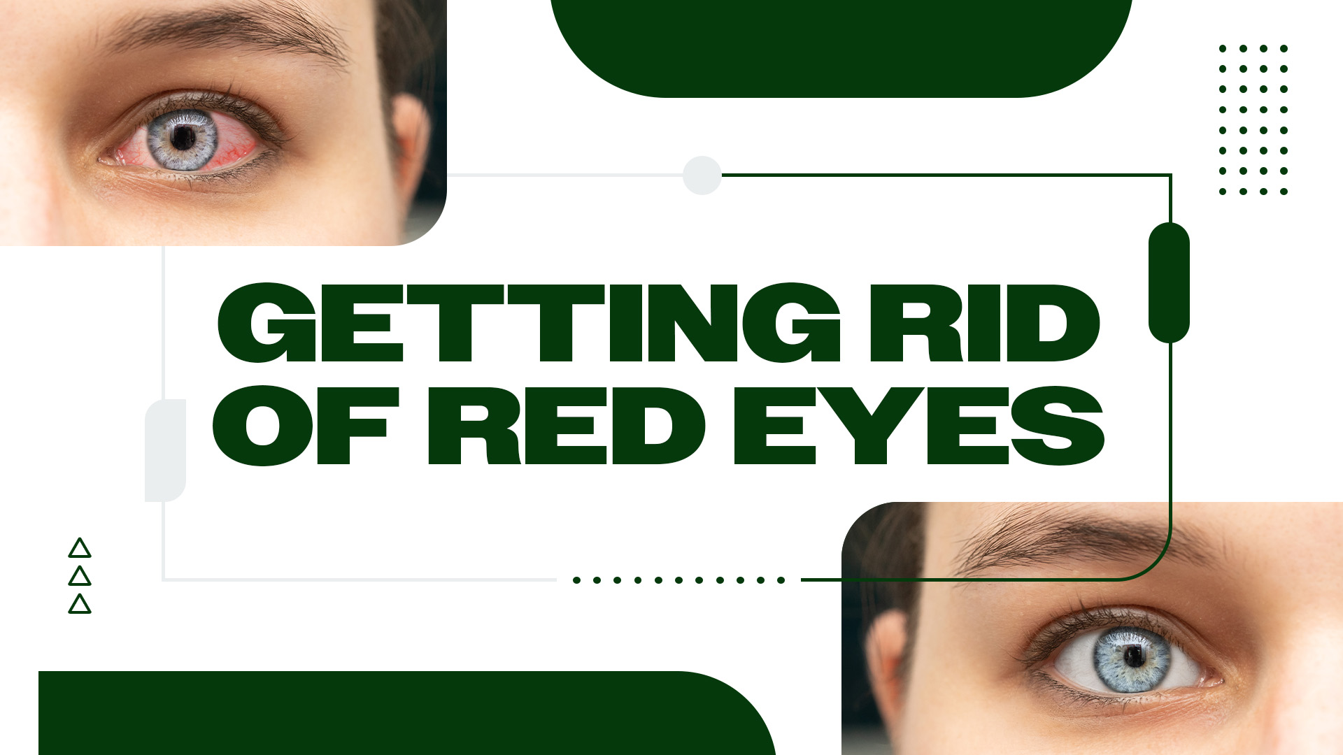 How to Get Rid of Stoned Eyes Fast: Quick and Easy Tips