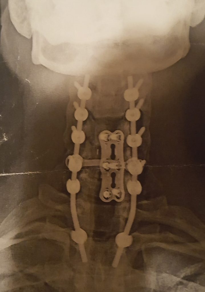 X-Ray critical neck surgery