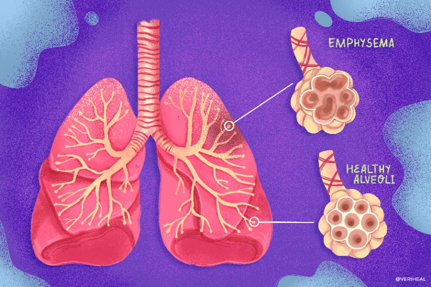 Medical Marijuana for the Treatment of COPD | Cannabis & COPD