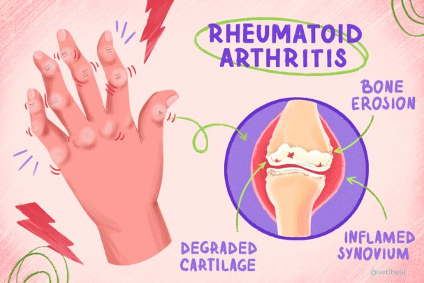 Medical Marijuana for Rheumatoid Arthritis | Cannabis for Arthritis